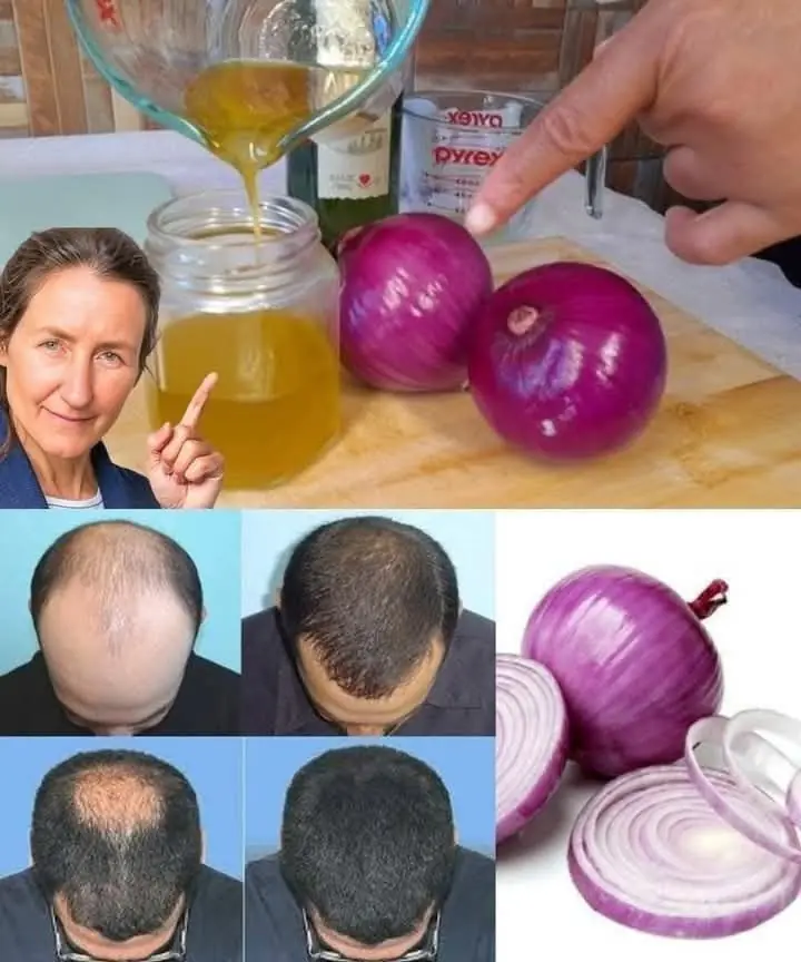 How to Make Onion Hair Oil for Faster Hair Growth and to Stop Hair Fall