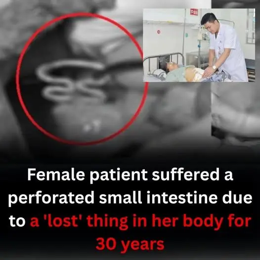 A Lost Object in Her Body for 30 Years: A Silent Cause of a Small Intestine Perforation