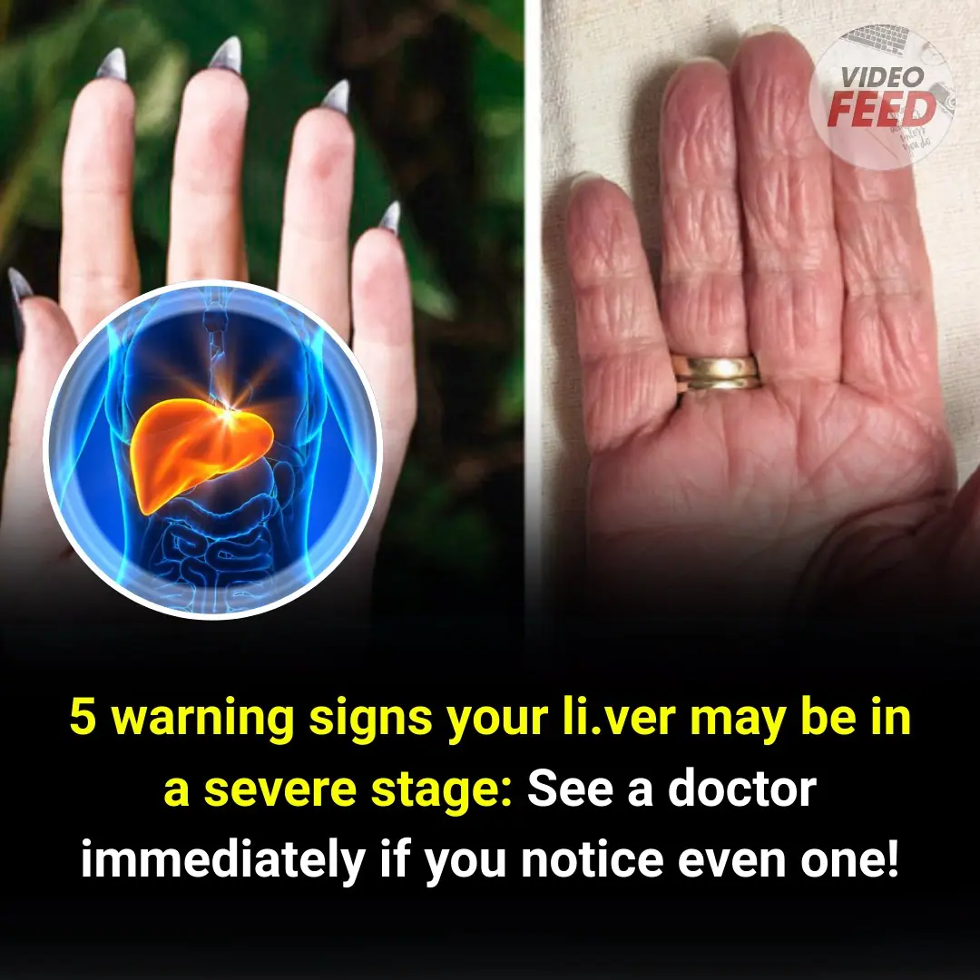Don't Ignore These Warning Signs: 5 Indications That Your Liver May Be in Serious Trouble