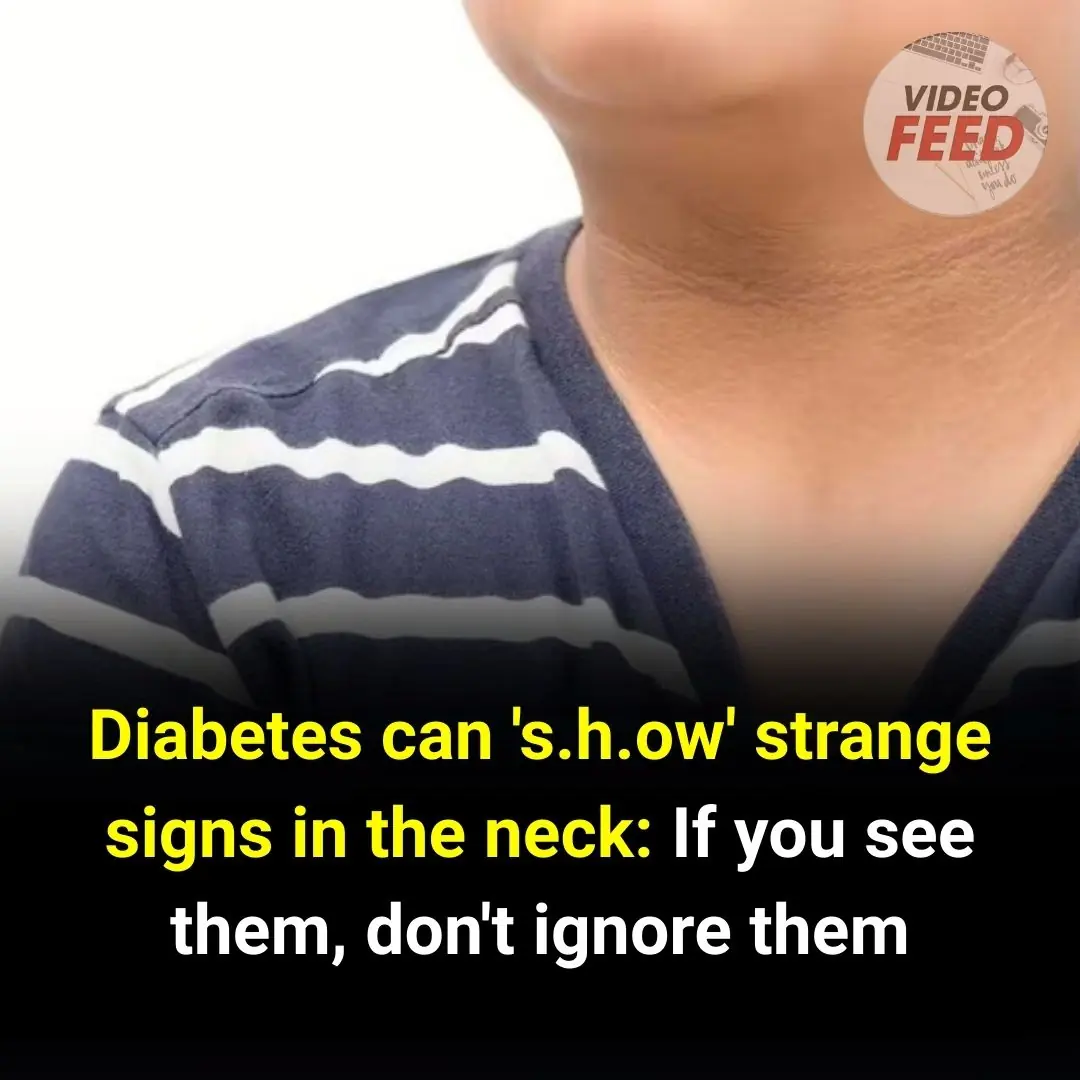 Strange Signs Around the Neck That Could Signal Diabetes