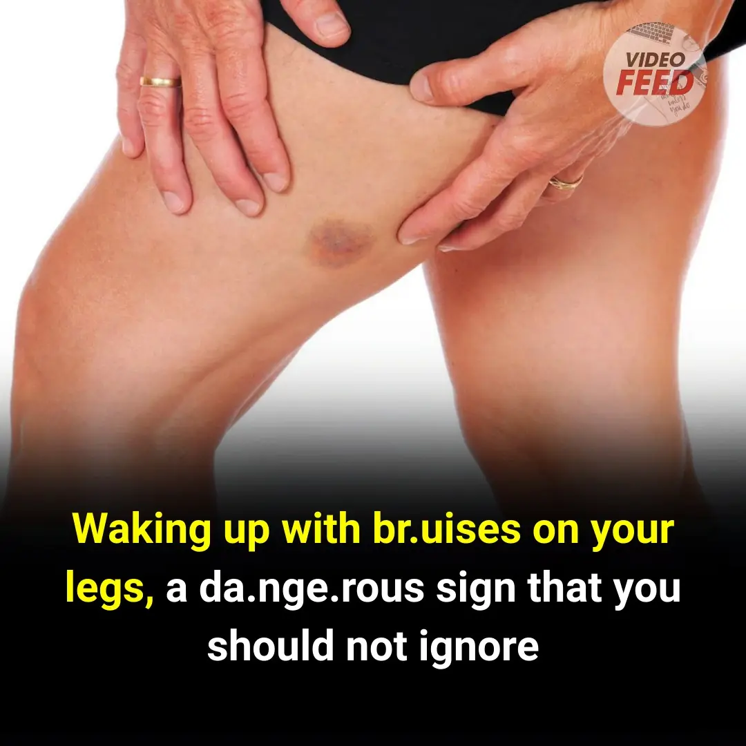 Waking Up with Bruises on Your Legs: Dangerous Signs You Shouldn't Ignore