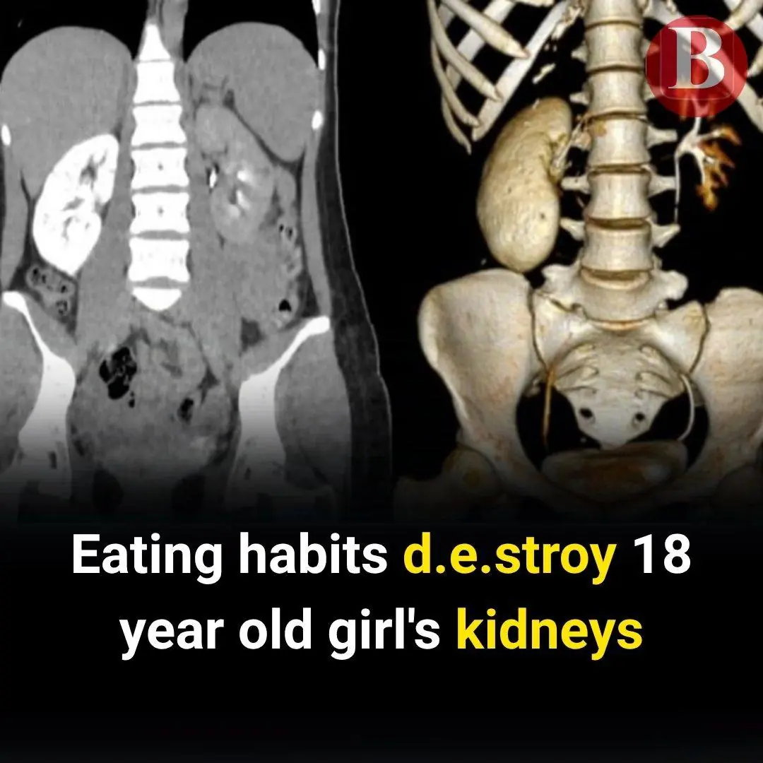 Unhealthy Eating Habits That Nearly Turned an 18-Year-Old's Kidneys to Stone